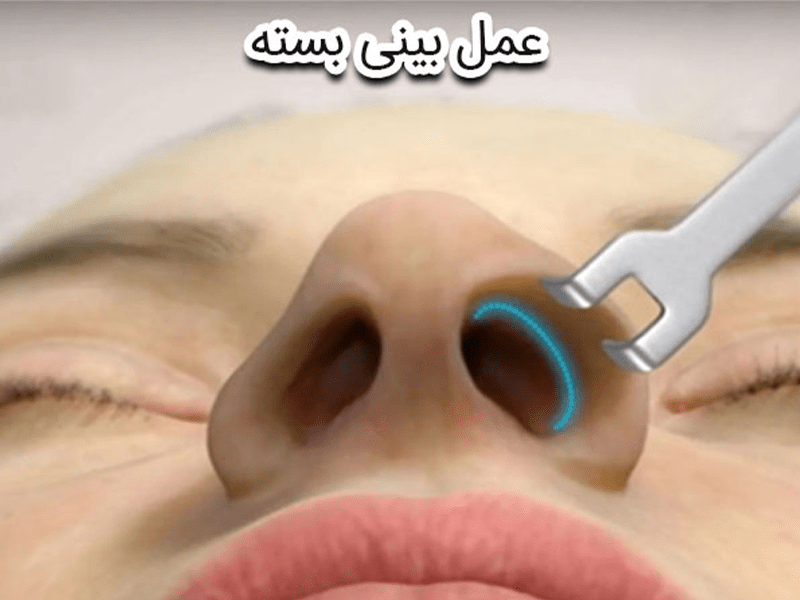 جراحی بینی به روش بسته