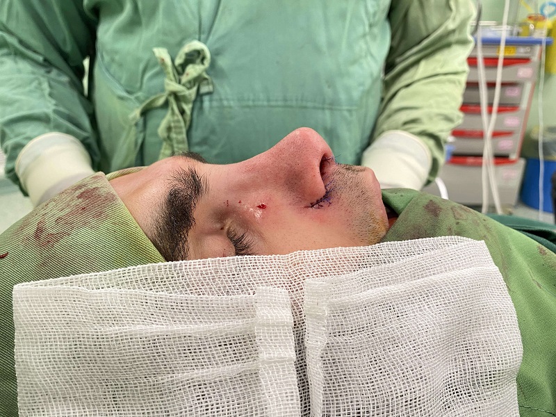 جراحی راینوپلاستی در شیراز