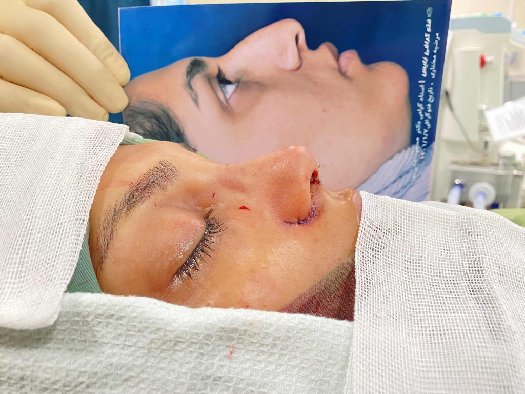 مزایای انجام جراحی انحراف بینی در شیراز