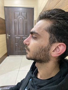 جراحی انحراف بینی در شیراز - دکتر جانی پور