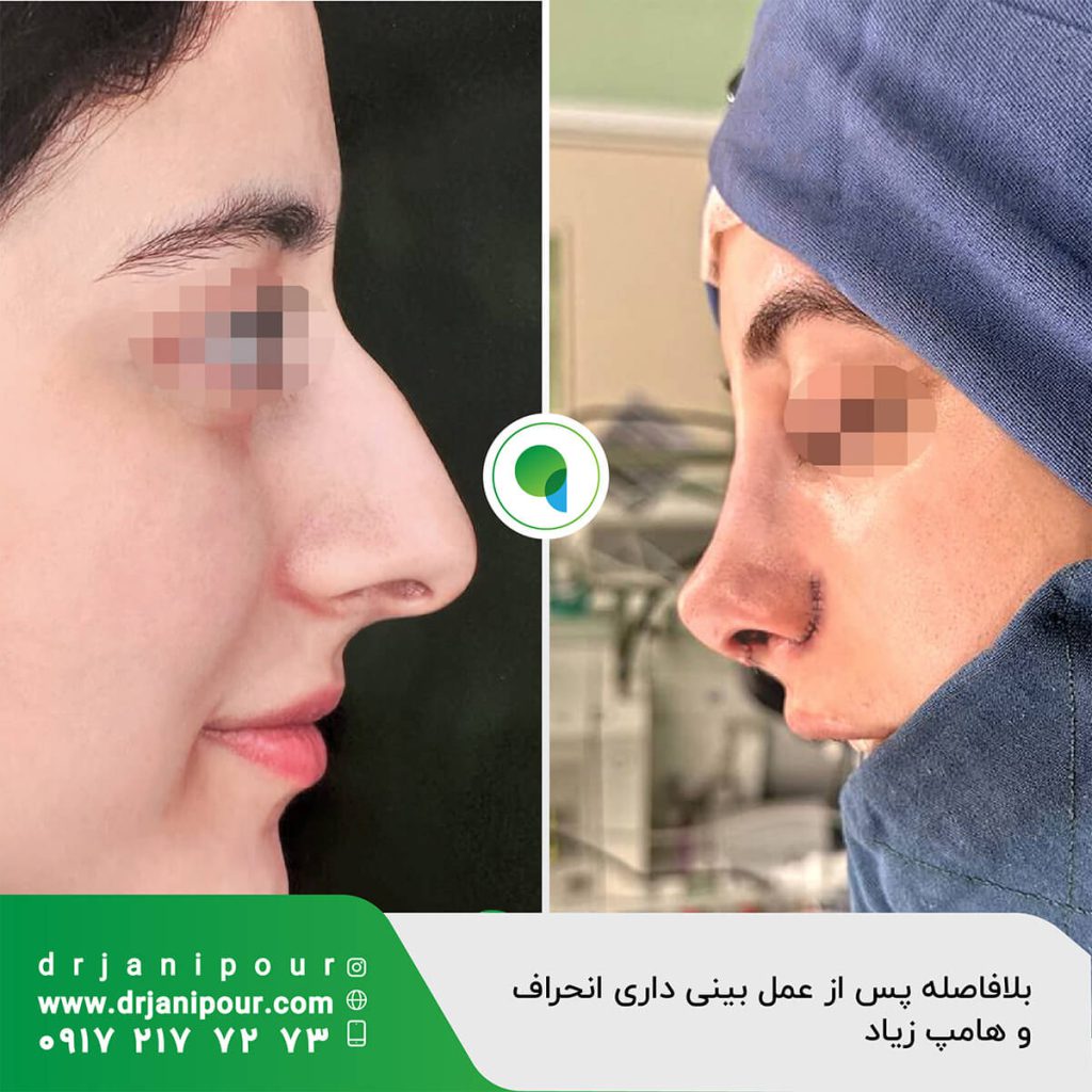 بلافاصله بعد از عمل بینی دارای انحراف و هامپ زیاد