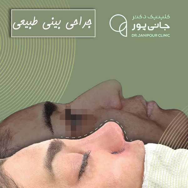 جراحی بینی طبیعی در شیراز - دکتر جانی پور