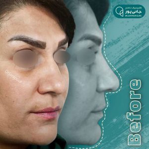 جراحی بینی در شیراز - دکتر جانی پور